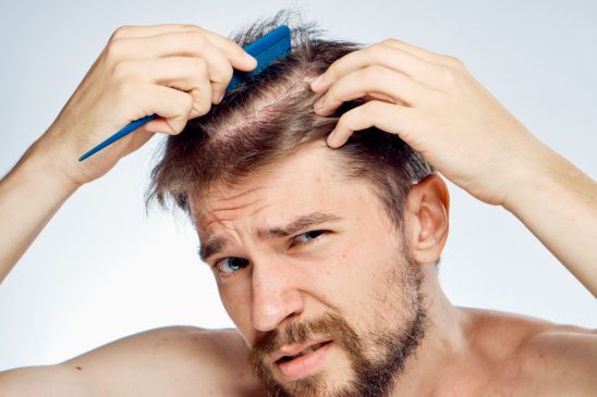 What Are the Causes of Hair Loss in Men?